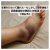 足首をひねって腫れた実写風の画像（内出血あり）